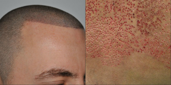 Կրծքավանդակի մազերը գլխին փոխպատվաստելուց հետո տղամարդը ցավալի տեսք ունի (լուսանկար)